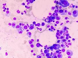 Microscopic view of bone marrow slide feature are suggestive Multiple myeloma, also known as myeloma, is a type of bone marrow cancer. photo