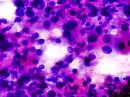 Cytological study of intra abdominal mass, Spindle cell sarcoma, positive for malignant cells. Pleomorphic undifferentiated sarcoma, malignant fibrous histiocytoma. photo