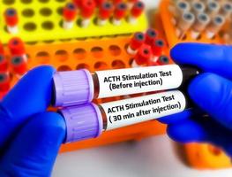 Scientist holding blood samples for ACTH Stimulation test. short Synacthen test. Before injection and after injection photo