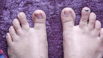 Close up of womans infected toe video