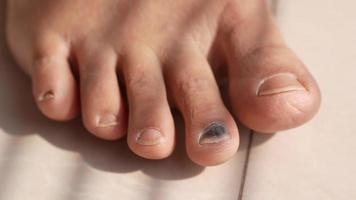 Close up of womans infected toe video