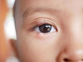 Closeup of Infected child eye patch with painful bump on lower eyelid. eye disease photo