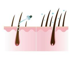 Hair density treatment vector illustration isolated on white background.
