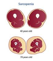 Sarcopenia vector illustration isolated on white background.