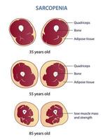 Infographic of sarcopenia vector illustration isolated on white background.