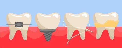 A set of teeth on the gums with braces, a false tooth, clean with dental floss, with tartar and plaque. The teeth are different on the gums. Illustration in a flat style vector