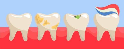 A set of teeth on the gums is a healthy tooth, plaque on the teeth, a tooth with caries, a tooth with striped toothpaste. The teeth are different on the gums. Illustration in a flat style vector