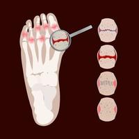 ARTHRITIS LEG Rheumatoid Medicine Education Vector Scheme Set