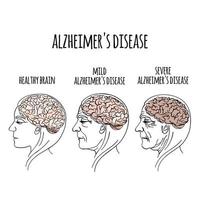 demencia Alzheimer enfermedad medicina vector ilustración