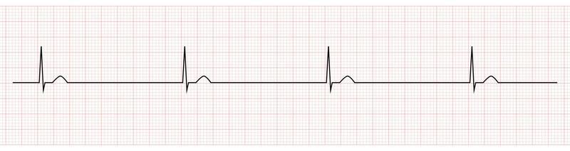 EKG Monitor Showing  junctional bradycardia
