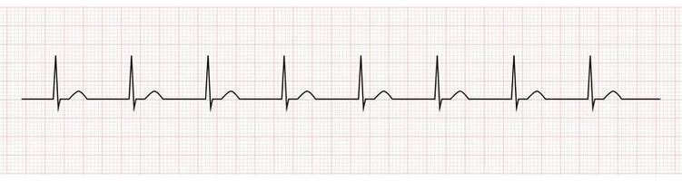 EKG Monitor Showing accelerated junctional rhythm vector