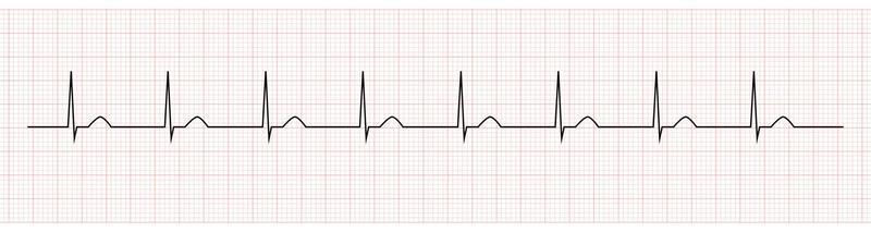 EKG Monitor Showing accelerated junctional rhythm