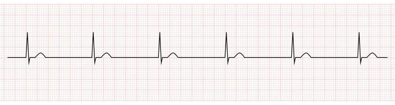 EKG Monitor Showing junctional escape rhythm