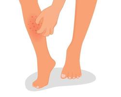 Man hand scratching his itchy leg with rash dry skin because of allergic reaction vector