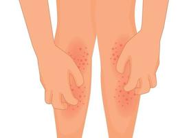 manos rascarse que produce picor pierna con erupción seco piel porque de alérgico reacción vector