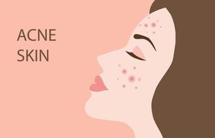 Young woman face with skin acne, pimples, blackheads vector illustration. Acne skin face problem concept