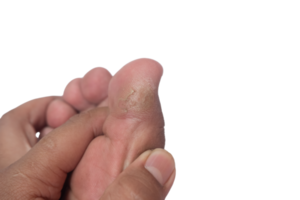 ein des Mannes Hand zeigen ein Kallus auf das groß Zehe png