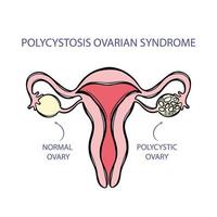 POLYCYSTOSIS OVARIAN SYNDROME Female Reproductive System vector