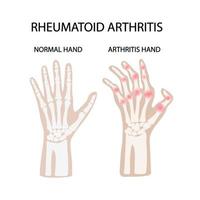 reumatoide artritis lesiones medicina educación vector esquema
