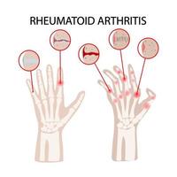 reumatoide artritis enfermedad medicina educación vector esquema