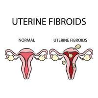 UTERINE FIBROIDS VS NORMAL Female Reproductive Education Set vector