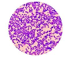 Synovial Fluid Cytology, Plenty WBC, microscopic examination of synovial fluid, to diagnose arthritis, particularly for septic or crystal-induced arthritis. photo