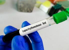 Blood sample for Lupus Erythematosus or LE test, an autoimmune disease in which the immune system attacks its own tissues causing widespread inflammation and tissue damage. photo