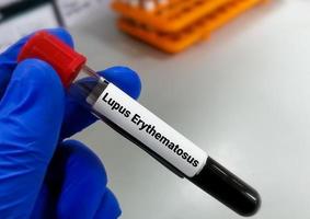 Blood sample for Lupus Erythematosus or LE test, an autoimmune disease in which the immune system attacks its own tissues causing widespread inflammation and tissue damage. photo