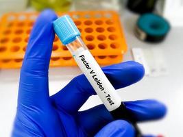 Blood sample for Factor V Leiden test, a mutation of clotting factors in the blood which may increase the chance of developing abnormal blood clots, most commonly in legs and lung. photo