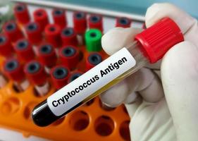 Blood sample for Cryptococcus Antigen test. photo