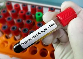 Blood sample for Cryptococcus Antigen test. photo