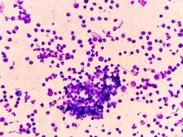 Synovial Fluid Cytology, Plenty WBC, microscopic examination of synovial fluid, to diagnose arthritis, particularly for septic or crystal-induced arthritis. photo