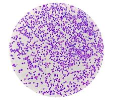 Synovial Fluid Cytology, Plenty WBC, microscopic examination of synovial fluid, to diagnose arthritis, particularly for septic or crystal-induced arthritis. photo