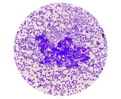 Synovial Fluid Cytology, Plenty WBC, microscopic examination of synovial fluid, to diagnose arthritis, particularly for septic or crystal-induced arthritis. photo