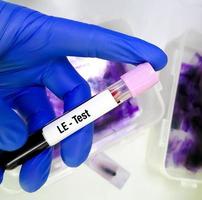 Blood sample for Lupus Erythematosus or LE test, an autoimmune disease in which the immune system attacks its own tissues causing widespread inflammation and tissue damage. photo