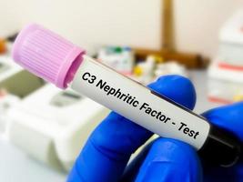 C3 Nephritic Factor test. C3NFs is an autoantibody to the alternate complement pathway's C3 convertase. photo