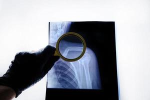 X-ray image broken human collarbone is viewed through magnifying glass.