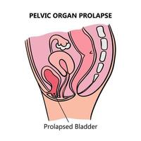 PROLAPSED BLADDER Of Women Medical Education Scheme Vector Set