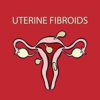 uterino fibromas hembra reproductivo medicina educación vector