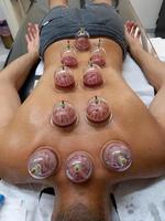 Vacuum cupping treatment traditional medicine photo