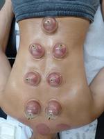 Vacuum cupping treatment traditional medicine photo