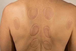 Mature man that had Cupping Therapy done on his back for pain relief photo