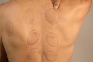 Mature man that had Cupping Therapy done on his back for pain relief photo