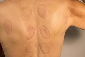 Mature man that had Cupping Therapy done on his back for pain relief photo