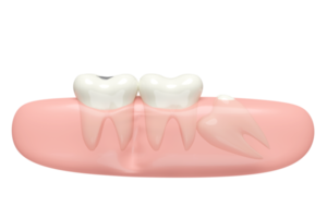 3d Weisheit Zähne Modell- Probleme Symbol mit Zahnfleisch isoliert. Dental Untersuchung von das Zahnarzt, Gesundheit von Weiß Zähne, Oral Pflege, 3d machen Illustration png