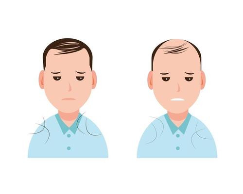Male pattern baldness, alopecia, type of hair loss in men vector isolated on white background. Hair problem concept illustration.