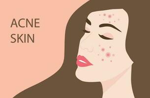 Young woman face with skin acne, pimples, blackheads vector illustration. Acne skin face problem concept