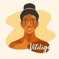 Character of Young Girl with Skin Problem Vitiligo on Background. vector