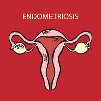 ENDOMETRIOSIS Female Reproductive System Medicine Education vector