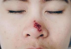 The Herpes simplex on asian woman nose, Herpes simplex is a viral disease caused by the herpes simplex virus. Infections are categorized based on the part of the body infected. photo